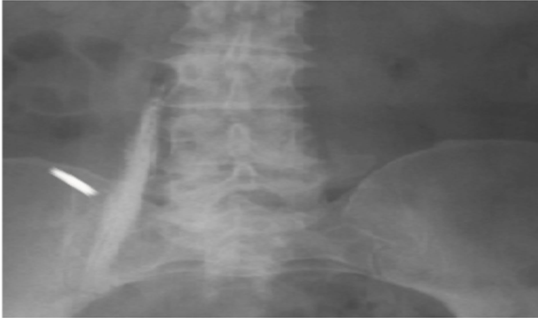 Continuous Lumbar Plexus Catheter Removal in Postoperative Total Hip