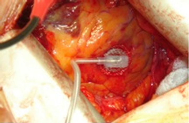 Surgical Results of Left Ventricular Lead Implantation for Cardiac Resynchronization Therapy