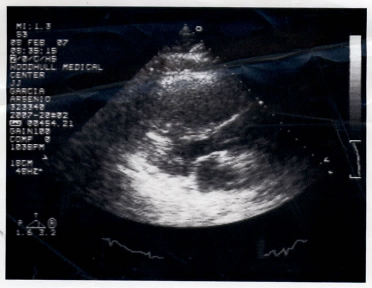 pulmonary embolism research paper pulmonary embolism research paper
