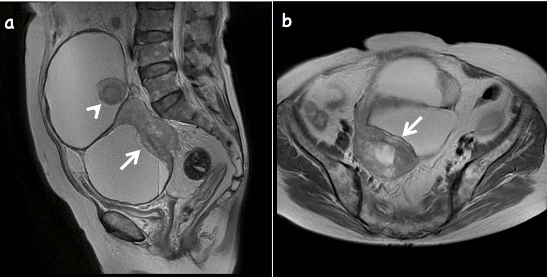 Final, Teratoma ovarian cyst Teratoma ovarian cyst very grateful