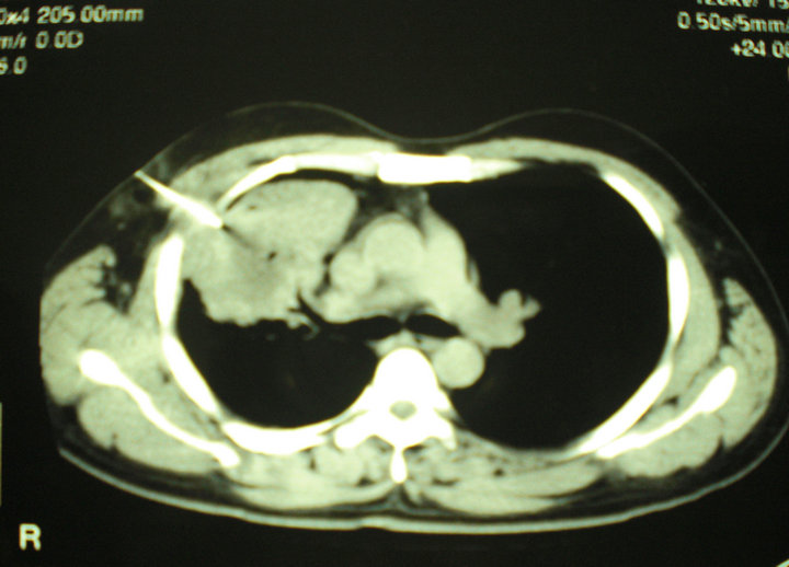 A Mass Shadow on Chest XRay in a 40YearOld Man What’s Your Diagnosis?