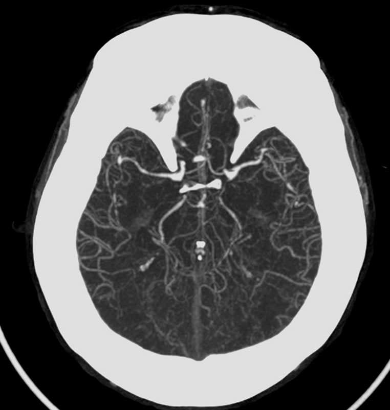 Visual Anosognosia (AntonBabinski Syndrome) Report of