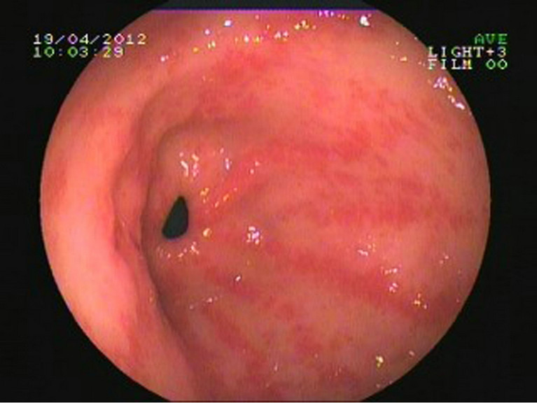 What are the stomach symptoms of gastritis in the antrum?
