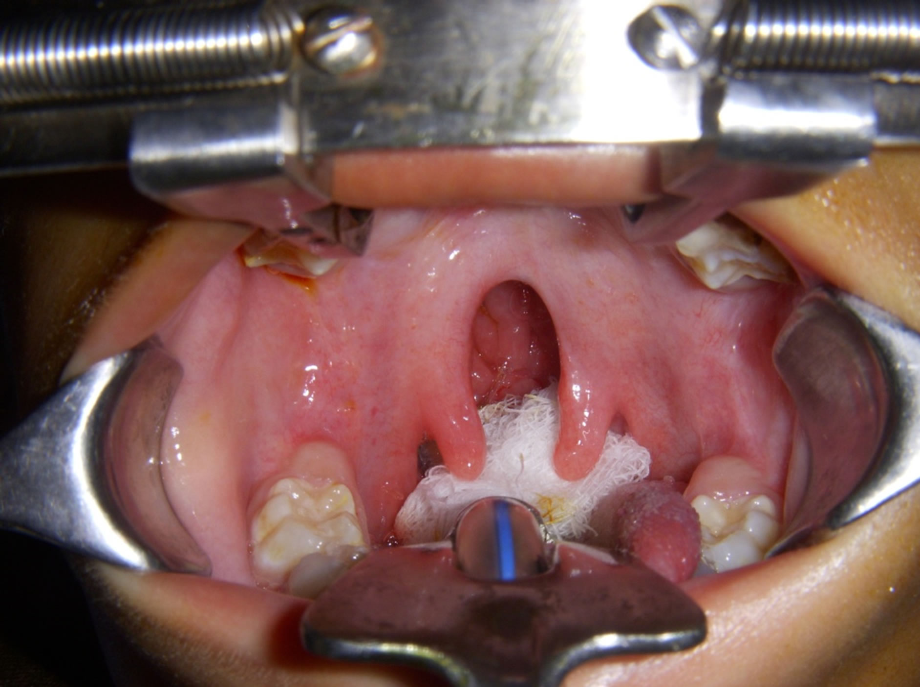 Perioperative Management of Cleft Palate Repair in a Patient with