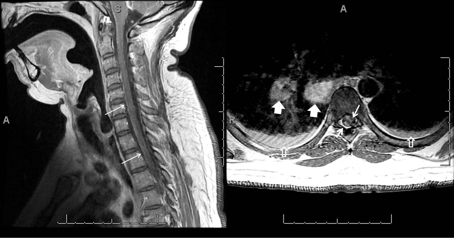 Normal cervical spine mri report multinodular