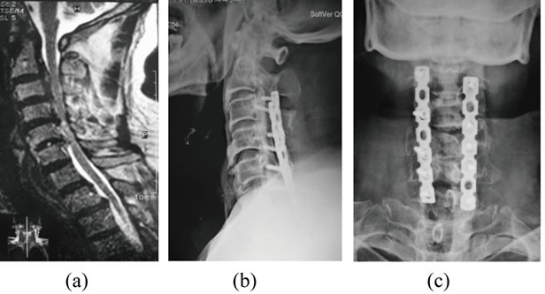 The Surgical Approaches of Cervical Spondylotic Myelopathy and the
