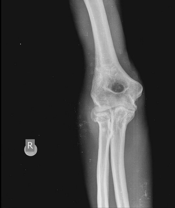 Synovial Chondromatosis of the Elbow Joint in a 27YearOld Man A Case