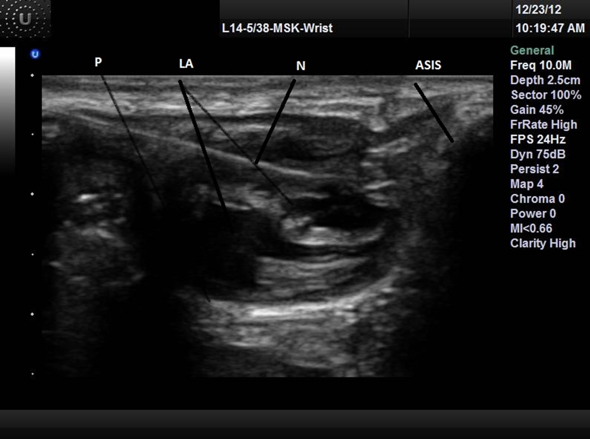 New Approach of Ultrasound-Guided Genitofemoral Nerve Block in Addition