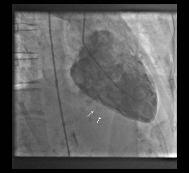 Variant Of Takotsubo Cardiomyopathy Associated With Sepsis And