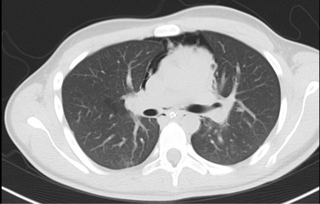 Pneumomediastinum after Orthognathic Surgery: Case Report ... Pneumomediastinum after Orthognathic Surgery: Case Report ...