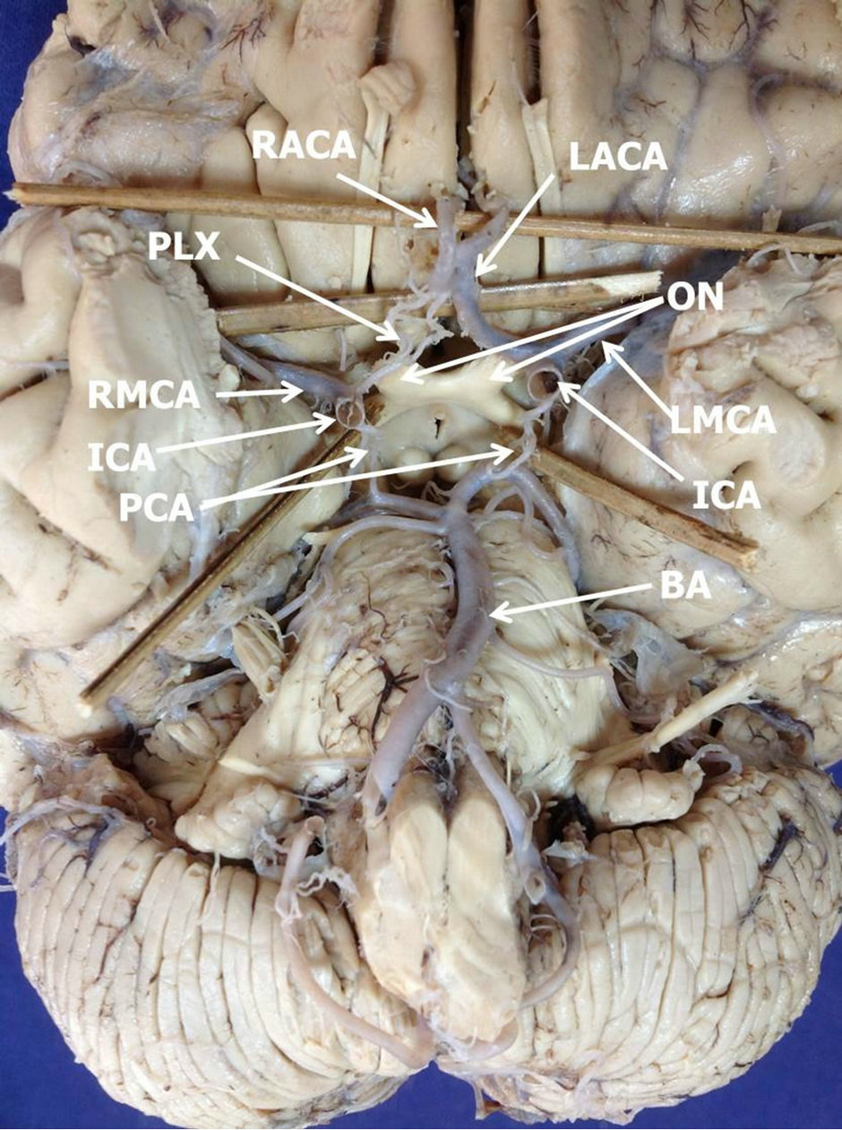 Hypoplastic plexiform right anterior cerebral artery and absence of