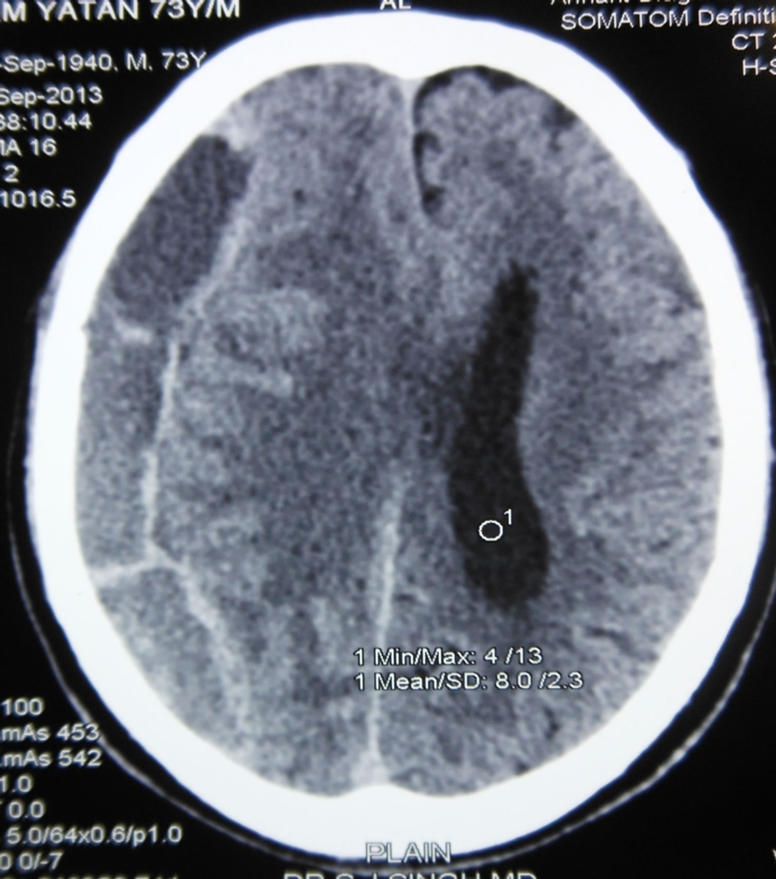 Acute on chronic subdural hematoma case report examples