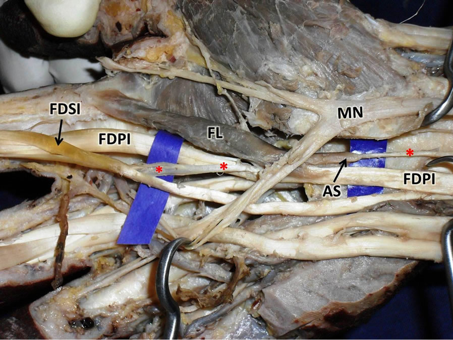 Multiple tendons of the additional belly of flexor pollicis longus in