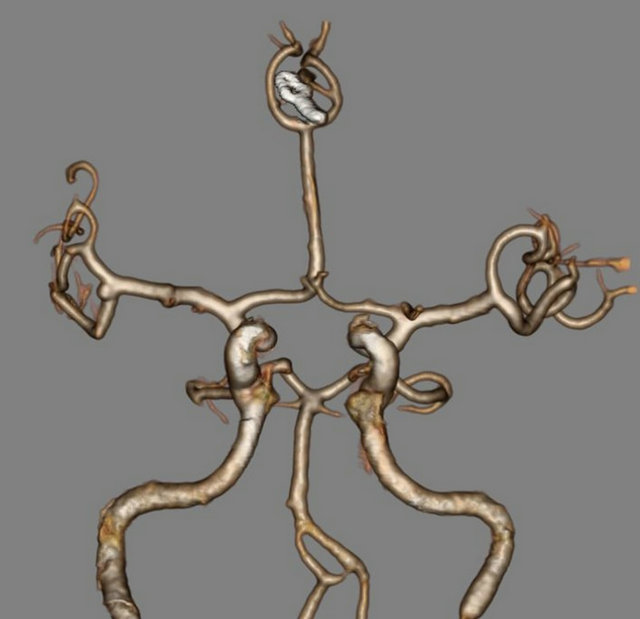 azygos, azygos anterior cerebral artery aneurysm with concomittant