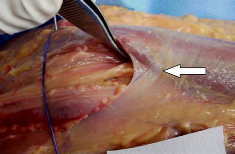 Potential Compressive Sites of the Anterior Interosseous Nerve in the
