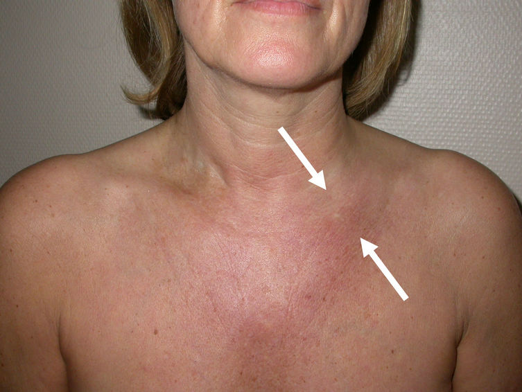 Pictures Of Patients With Clavicular Swelling 79