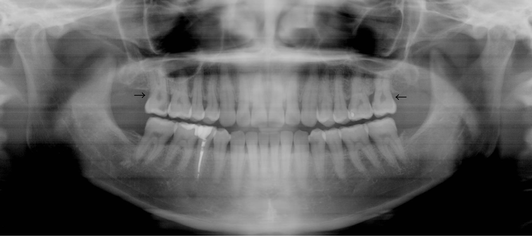 Removal of the Shadow of Cervical Vertebrae from Panoramic X-Ray Images