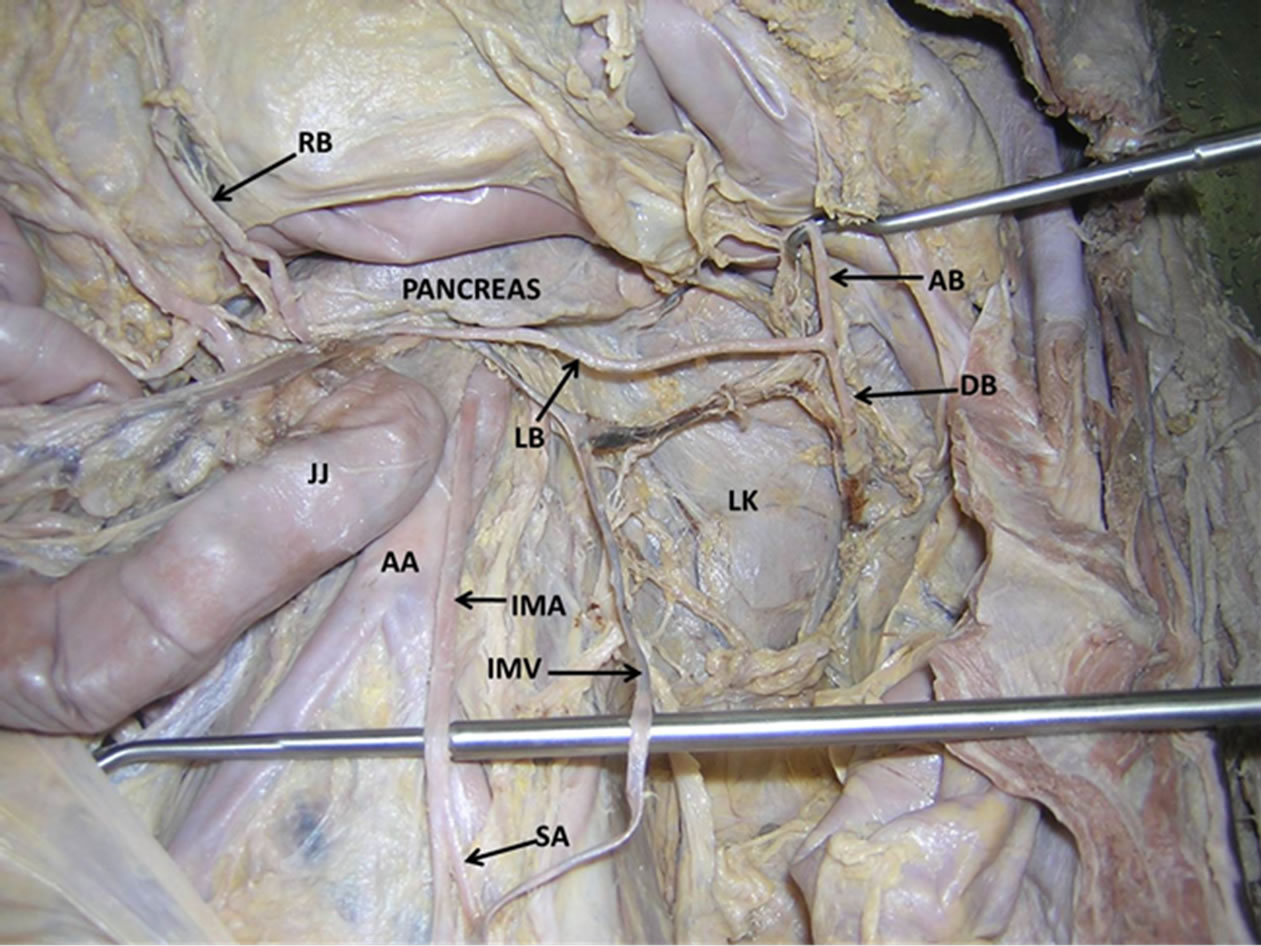 Anomalous origin and vulnerable course of left colic artery in relation