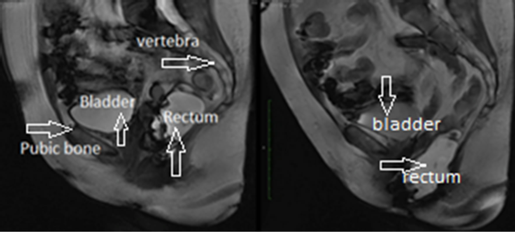 Image based measurements for evaluation of pelvic organ prolapse