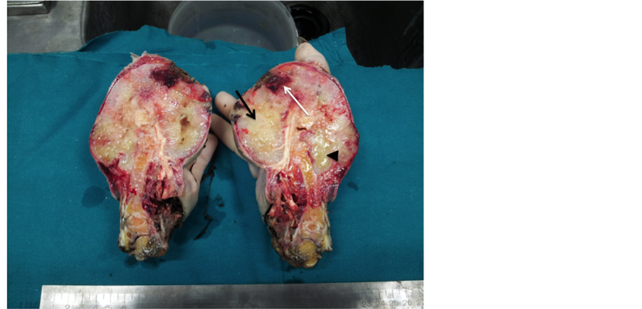 Figure 1 . High-grade chondrosarcoma of the III digit, infiltrating ...