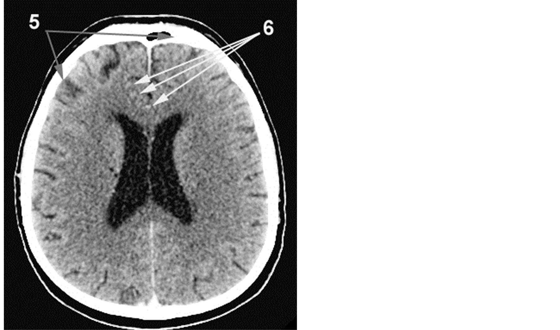Ischemic disease of the brain: a clinic and methods of treatment Ischemic disease of the brain: a clinic and methods of treatment