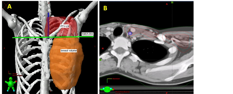 Risk of Radiation Induced Carotid Artery Stenosis in Supraclavicular