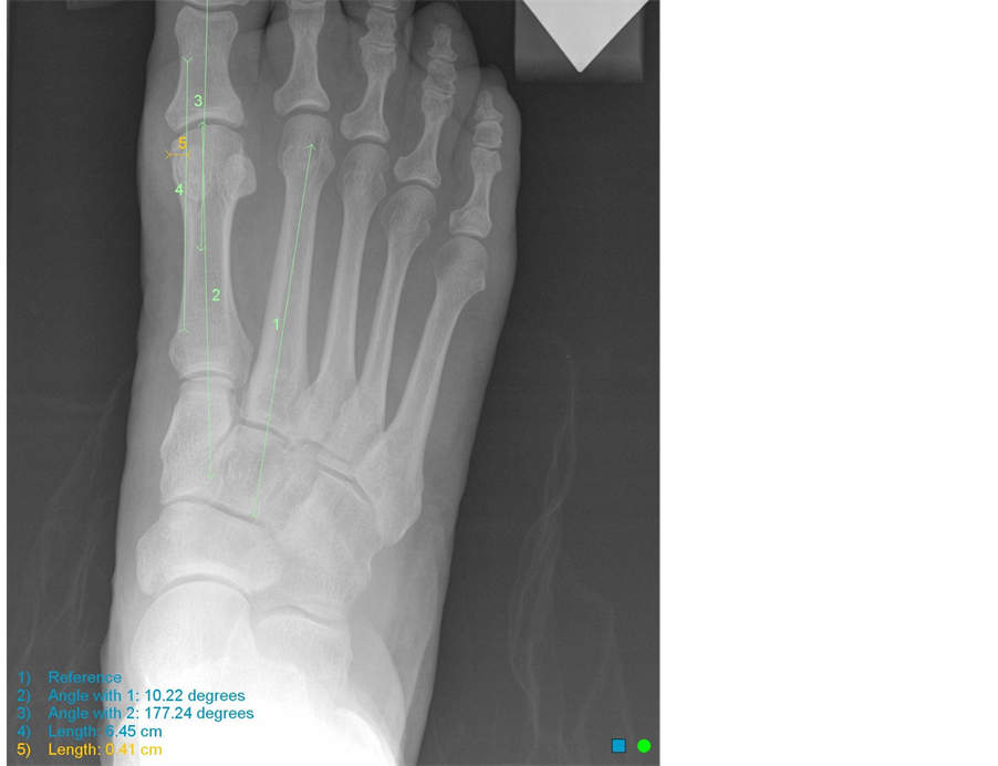 A Method for Measurement of the Hypertrophic First Metatarsal Medial