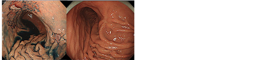 Endoscopic Diagnosis of Gastric MALT Lymphoma