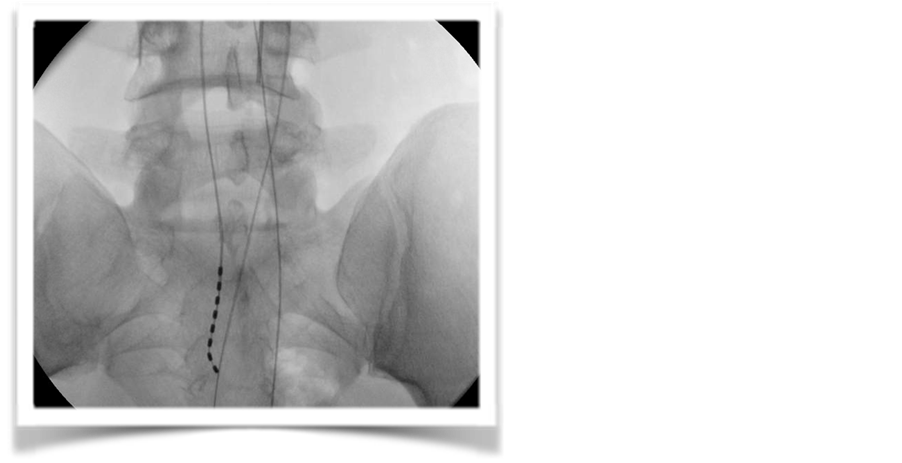Combined Sacral Nerve Roots Stimulation and Low Thoracic Spinal Cord