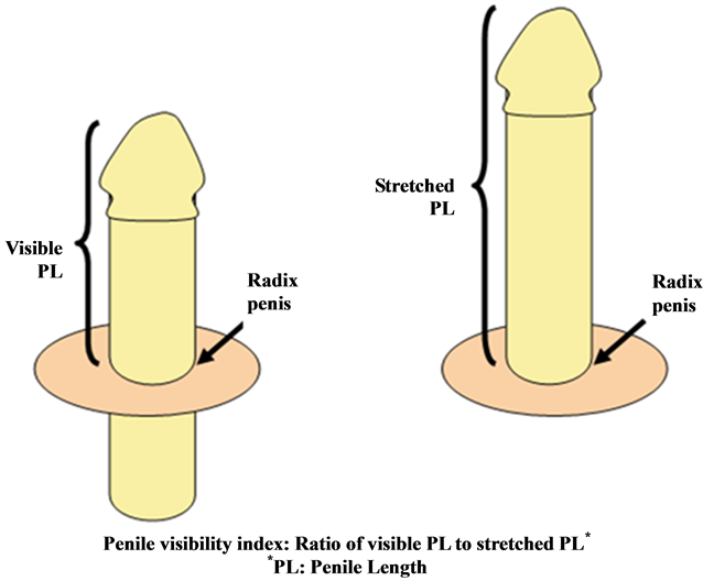 Webbed Penis Surgery