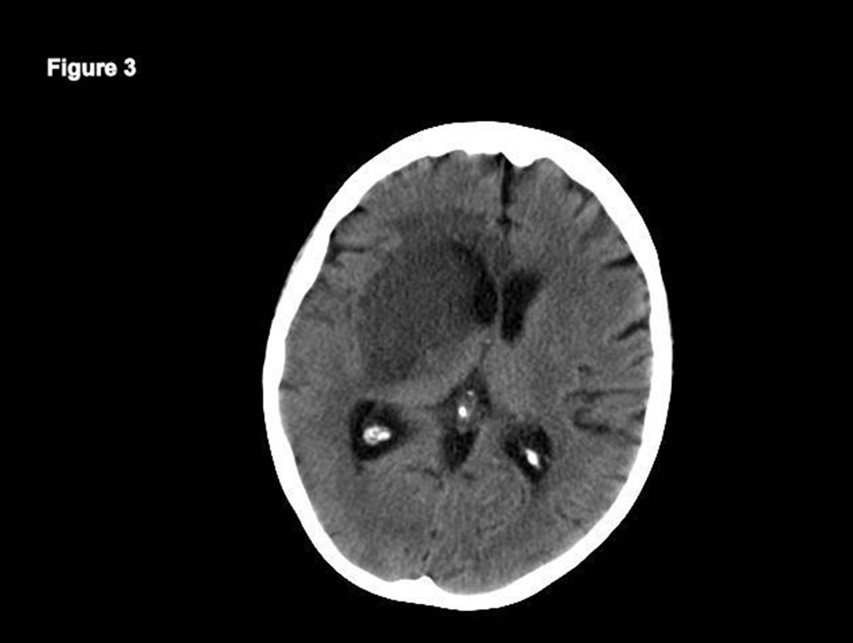 A Fatal Case of TreatmentRelated Adverse Effects in Granulomatosis