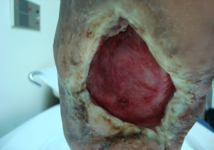 Healing of chronic diabetic foot ulcers with a skin substitute: Patient