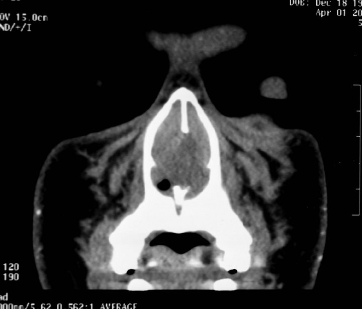 Spontaneous Nasal Septal Abscess Presenting As Complete Nasal Obstruction