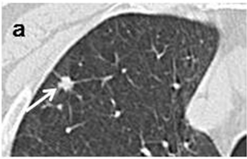 Stage 4 Lung Cancer >> Spreading pattern and CT findings of very early-stage peripheral small-cell lung cancer Stage 4 Lung Cancer >> Spreading pattern and CT findings of very early-stage peripheral small-cell lung cancer