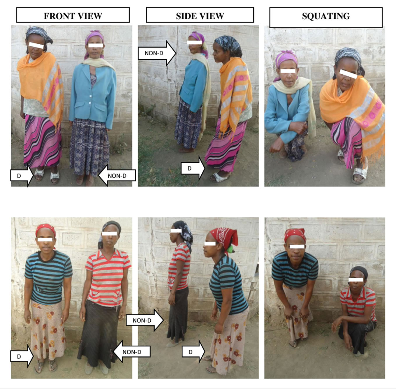 Chronic Alcohol Consumption and the Development of Skeletal Fluorosis