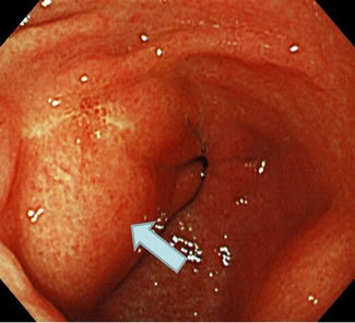 Lipoma of the Stomach Prolapsing into the Duodenal Bulb and Causing a
