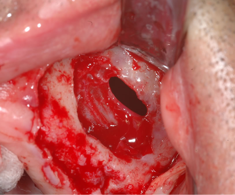 A simple method for repairing membrane sinus perforation