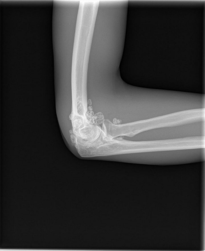 Synovial Chondromatosis of the Elbow Joint in a 27YearOld Man A Case