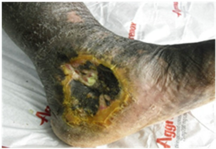 Management of Diabetic Foot Ulcers Using Negative Pressure with Locally