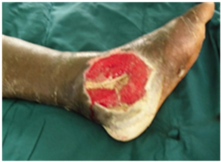 Management of Diabetic Foot Ulcers Using Negative Pressure with Locally