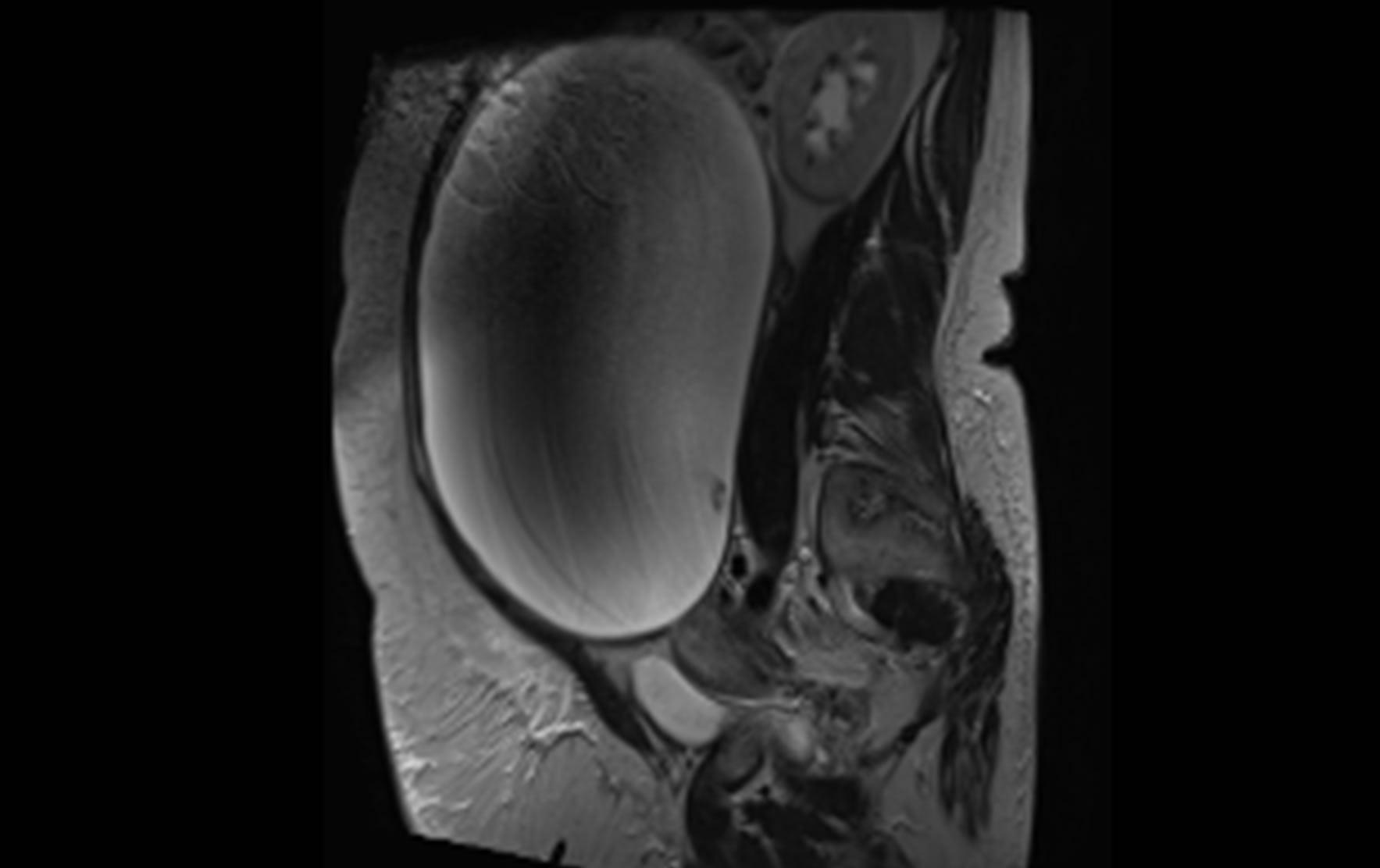 choice-of-skin-incision-for-a-massive-ovarian-cyst