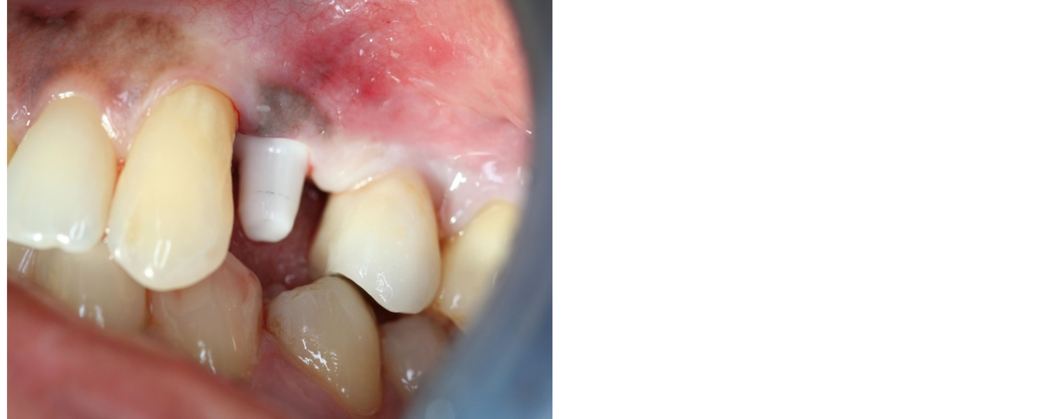 Corrosion aspect of dental implants—An overview and literature review