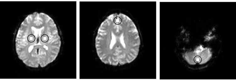 A Neighborhood Method for Statistical Analysis of fMRI Data