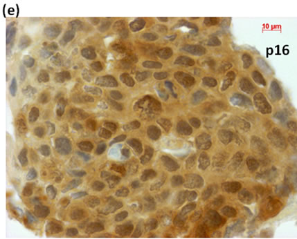 Use of Liquid-Based Cytology (LBC) and Cell Blocks from Cell Remnants ...