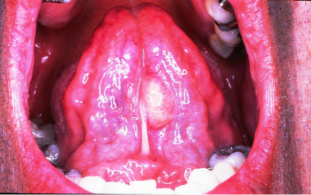 Spindle Cell Lipoma Of The Oral Cavity A Clinico -1056