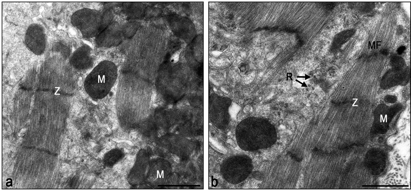 Effect of autologous mesenchymal stem cells induced by low level laser