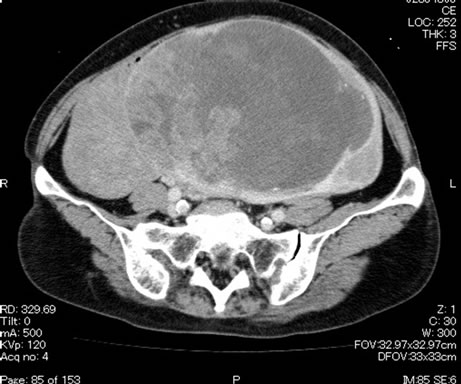 endometrial cancer on ct scan)