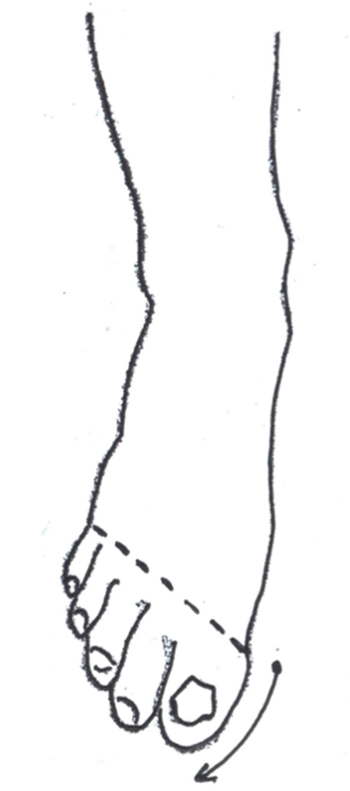 treatment-of-post-burn-scar-extended-deformity-of-the-toes-iv-degree