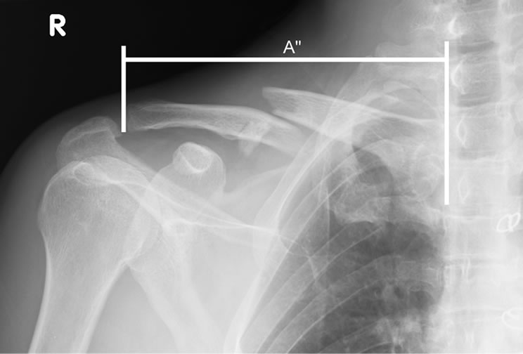Late Thoracic Outlet Syndrome after Clavicle Fractures in Patients with Multiple Trauma A