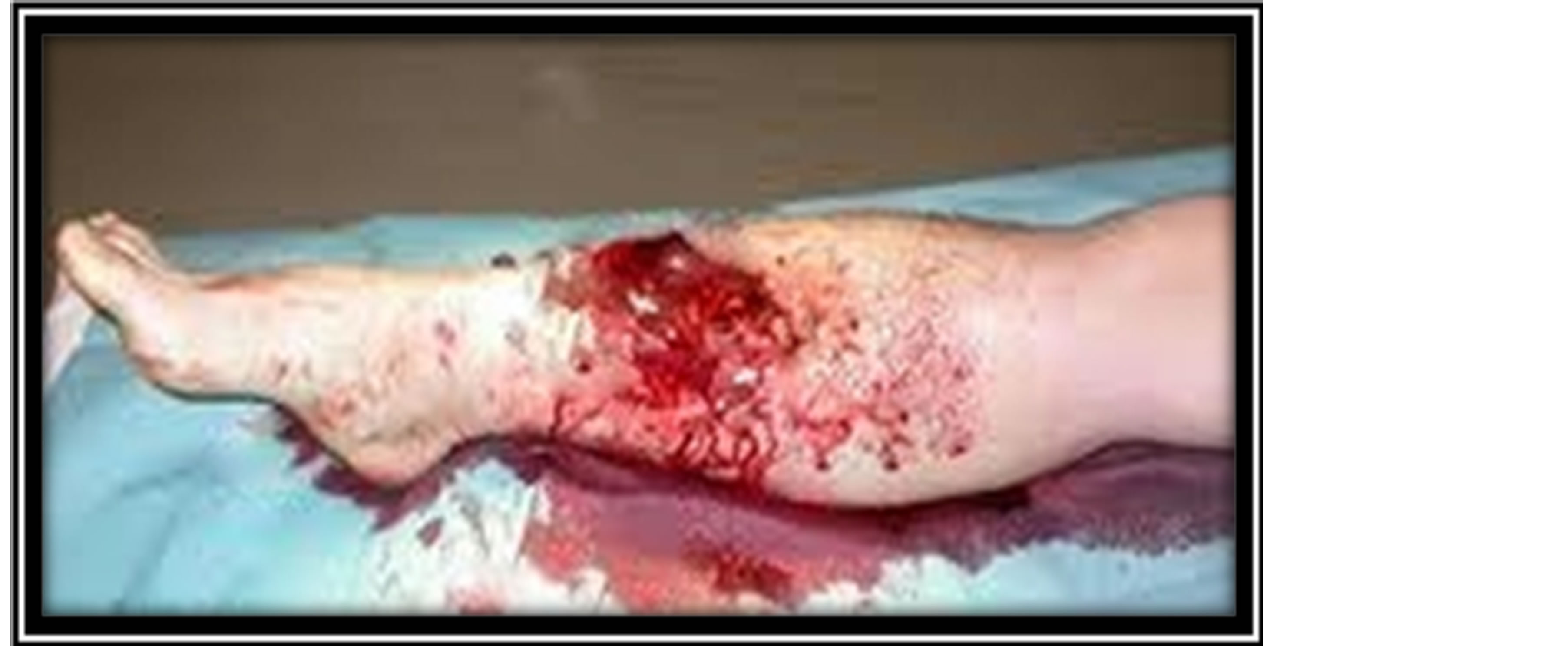 Open Fracture Tibia Treated by Unreamed Interlocking Nail. Long